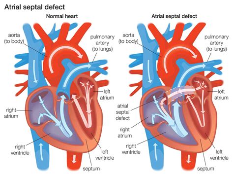 Toradh íomhá ar Atrial Septal Defect Classification