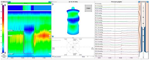Toradh íomhá ar Conventional Manometry vs High Resolution Manometry