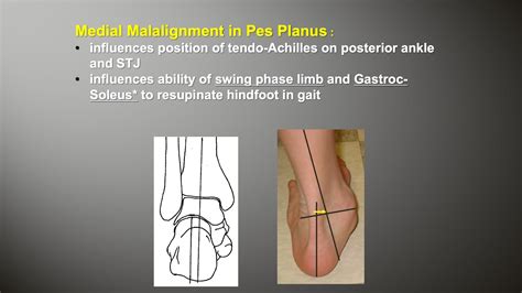 This Just In... - Pes Planus Part 1: - Biomechanics of Pes Planus Surgery