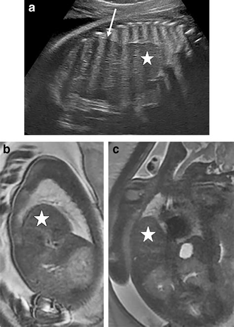 Toradh íomhá ar Hemi Diaphragmatic Eventration