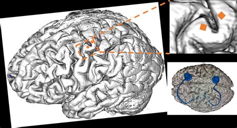 Image result for Utal Electrode Array