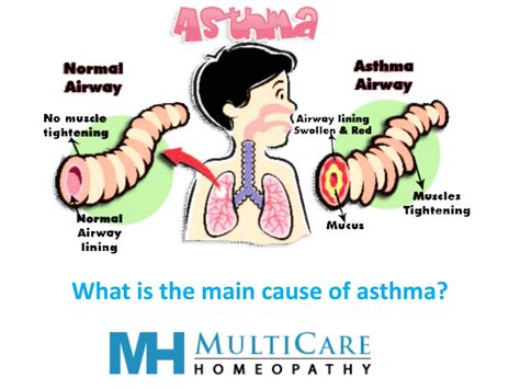 Image result for Asthma Exacerbation Table