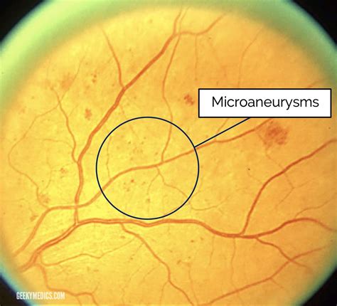 Toradh íomhá ar Fundoscopic Exam Diabetic Retinopathy