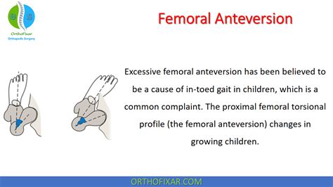 Toradh íomhá ar Femoral Anteversion vs Retroversion