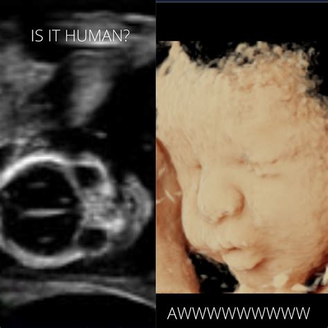 Image result for 3D/4D Ultrasound Exam