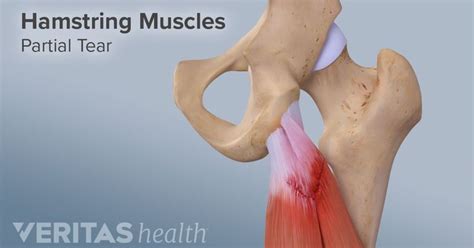 Résultat d’images pour Level 2 Hamstring Tear