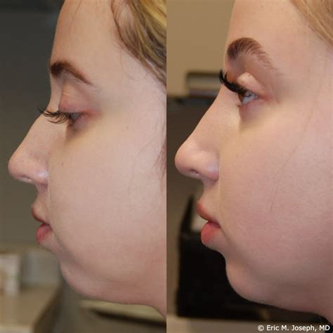 Afbeeldingsresultaten voor Bumpy Nose