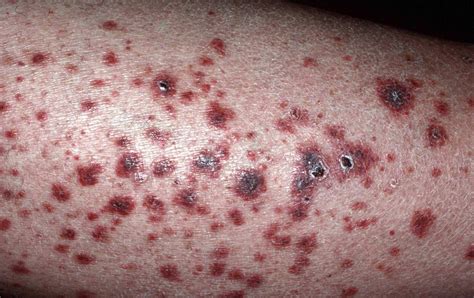 Vasculitis に対する画像結果