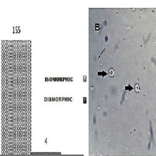 Image result for Dysmorphic RBC in Urine