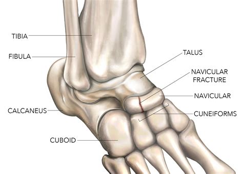 Résultat d’images pour Navicular Fracture Not Healing