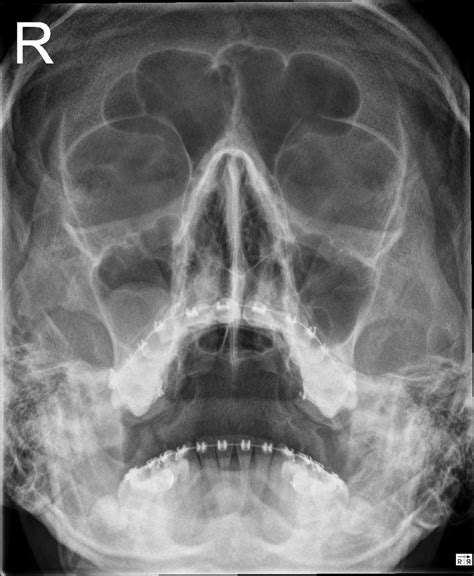Image result for Maxillary Cyst