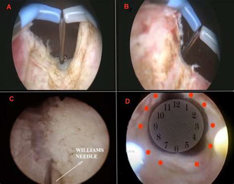 Bladder Neck Resection に対する画像結果
