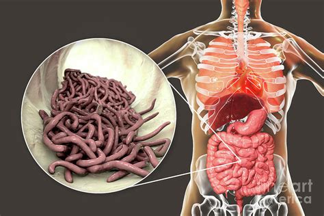 Image result for Worms in Humans