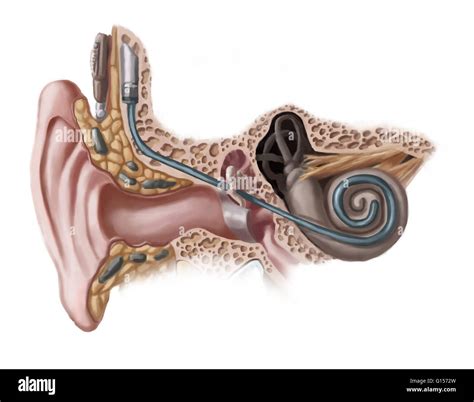Image result for Cochlear Implant Ear Diagram