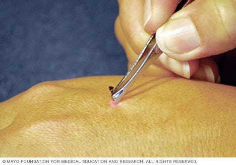 Image result for How to Remove a Bee Stinger