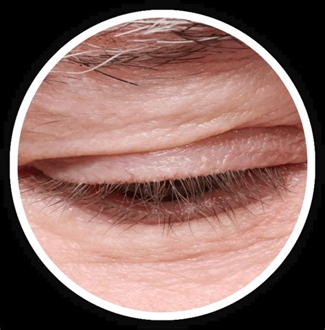 Toradh íomhá ar Blefaritis Demodex