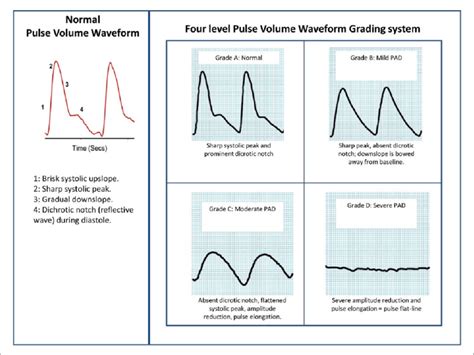 Image result for Digoxin Pulse Waveform