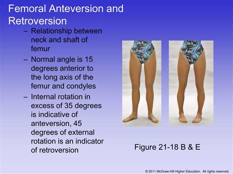 Image result for Femoral Retroversion Angle