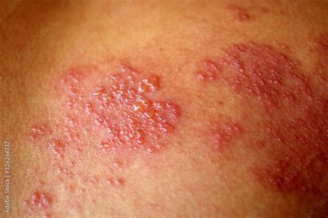 Rhus Dermatitis Face-এর ছবি ফলাফল