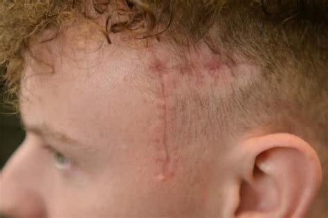 Image result for Scar On Right Side On Head