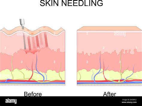 Toradh íomhá ar Before and After Needling Procedures