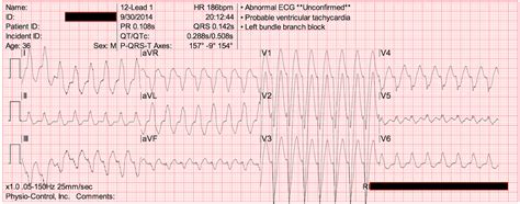 Image result for EKG Practice Test