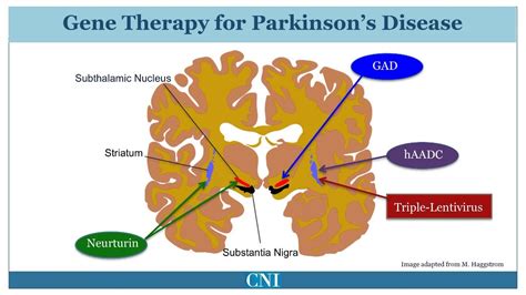 Afbeeldingsresultaten voor Parkinson's Disease Therapy