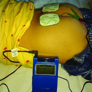 Transcutaneous Electrical Stimulation-এর ছবি ফলাফল