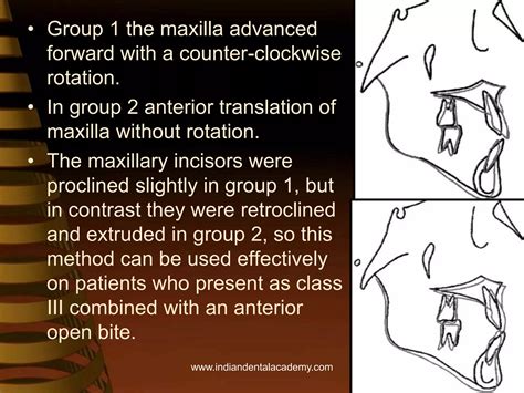 Image result for Maxillary Protraction