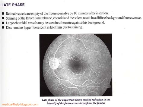 Image result for Recirculation Phase FFA
