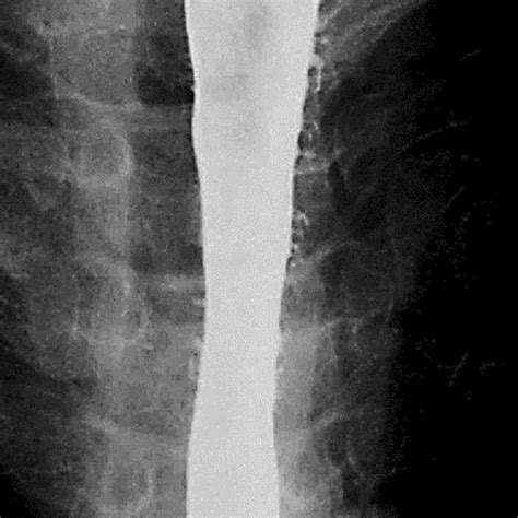 Image result for High Resolution Colonic Manometry Drawing