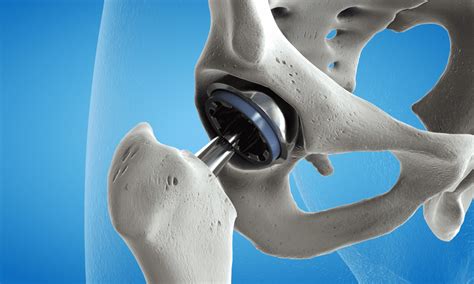 Image result for PF Joint-Replacement