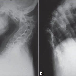 Afbeeldingsresultaten voor Angular Kyphosis TB Spine