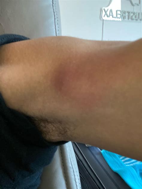 Image result for Painful Pimple Under Armpit