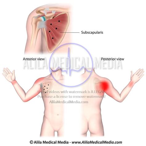 Image result for Subscapularis Nerve Pain