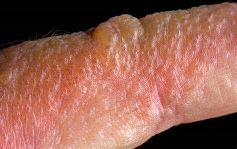 Rhus Dermatitis Face-এর ছবি ফলাফল