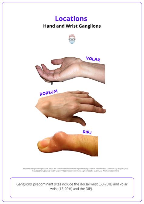 Toradh íomhá ar What Causes Ganglion Cyst