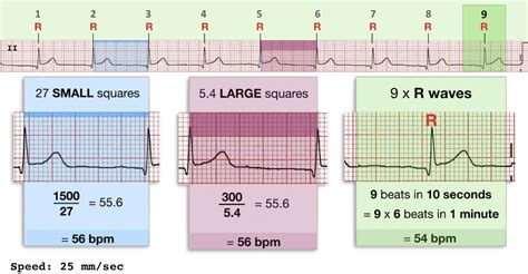 Image result for Normal EKG Measurement