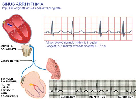 Image result for Sinus Rhythm Diagram