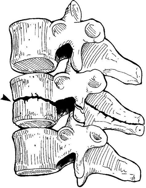 Toradh íomhá ar Dislocation Drawing
