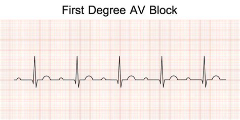 PR Interval - The Definitive Guide | Biology Dictionary
