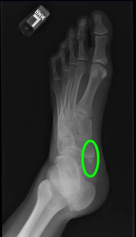 Image result for Navicular Bone Ankle
