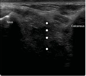 Image result for Subtalar Joint Injection vs Sinus Tarsi