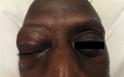 Image result for Eye Pops Out of Socket