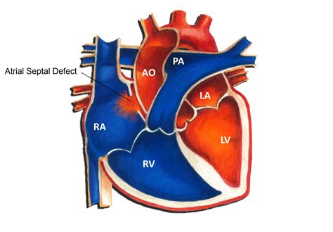 Toradh íomhá ar Ruis Atrium Septum Defect