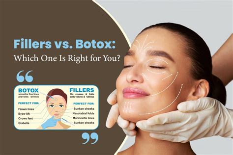 Image result for Botox vs Fillers