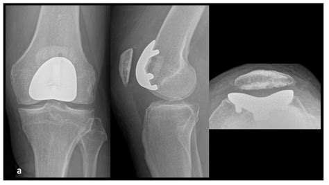 Image result for PF Joint-Replacement