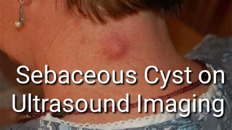 Image result for Lancing a Sebaceous Cyst