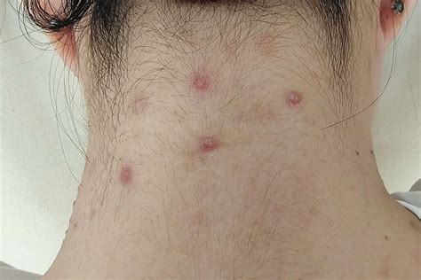 Inside Nodule Acne に対する画像結果