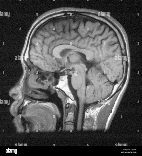 Toradh íomhá ar Normal Brain MRI Side View